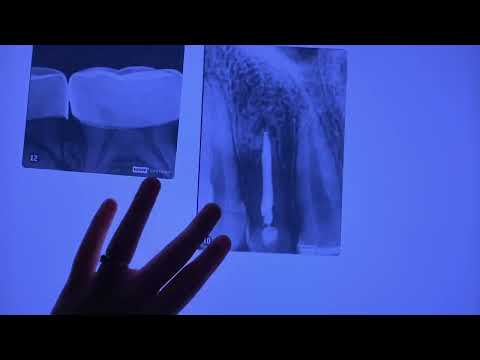 Dental X-Rays - 15 pc