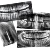 Dental X-Rays - 15 pc