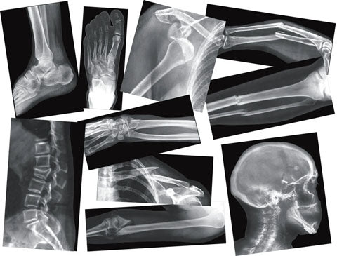Broken Bones X-Rays - 15 pc